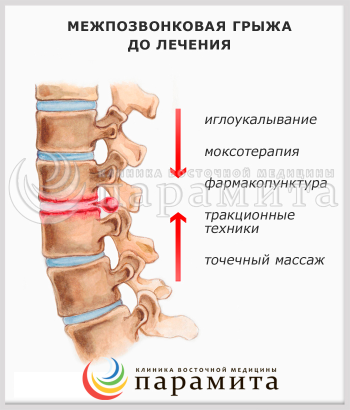 Лечение межпозвонковых грыж позвоночника в домашних условиях