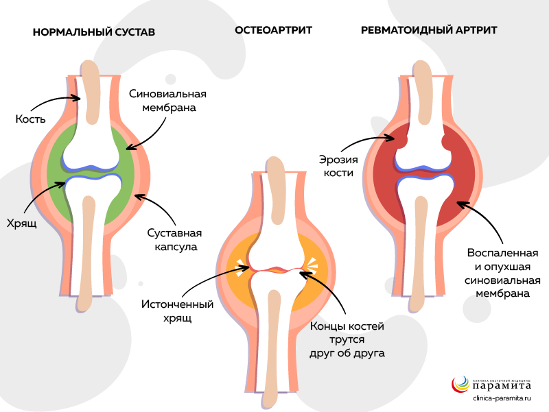 Патология суставов при ревматоидном артрите