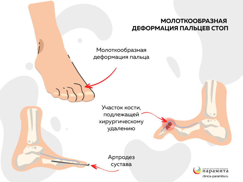 Ревматоидный артрит суставов стопы
