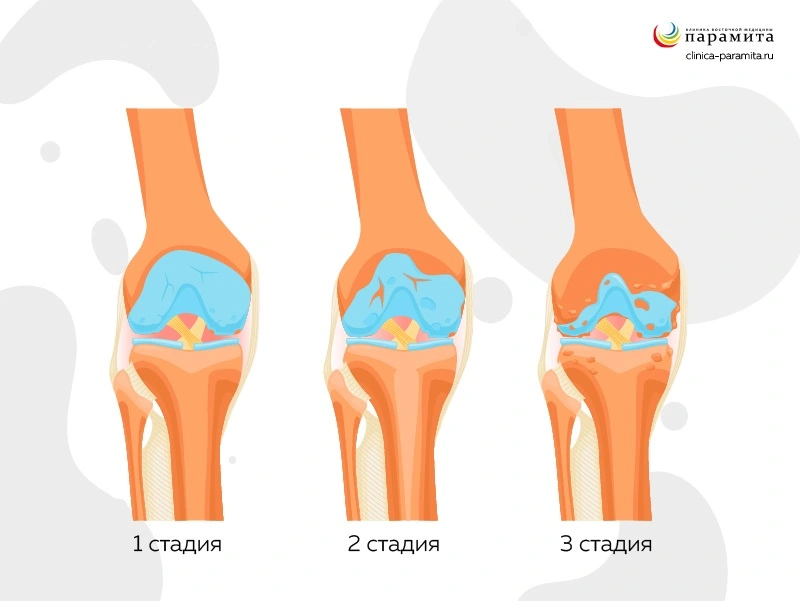 Артроз коленного сустава - причина болей под коленом