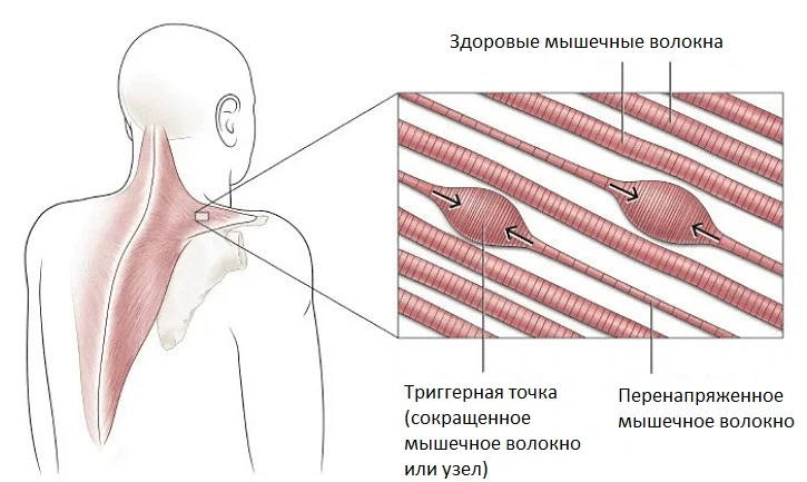 Миозит - распространенная причина болей в спине при кашле