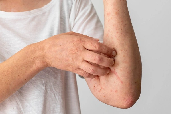 Дерматит - воспалительное кожное заболевание