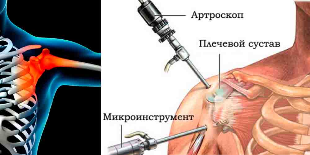 Какой операцией лечить артроз плечевого сустава