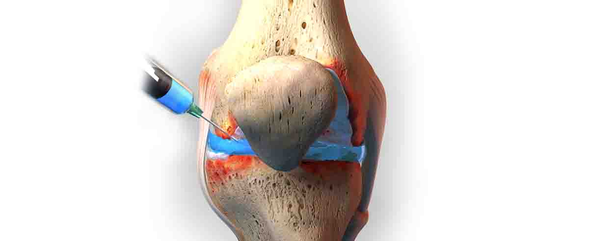 Схема проведение артроцентеза коленного сустава