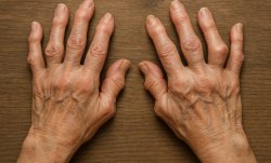 Серонегативный ревматоидный артрит