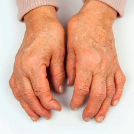 Артрит рук виды, причины и лечение