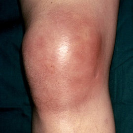 Почему появляется боль в коленном суставе?