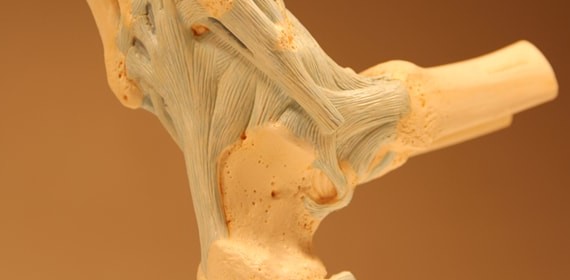 Артрит голеностопного сустава