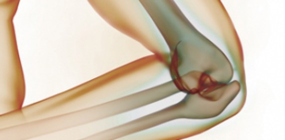 Артроз локтевого сустава