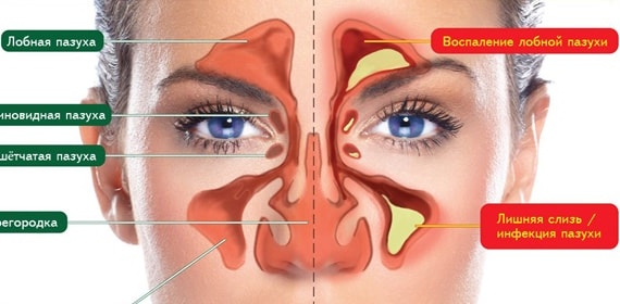 Что такое гайморит фото