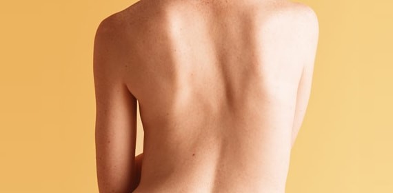 Правосторонний сколиоз