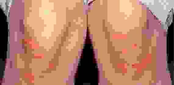 Псориаз