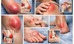 Причины бурсита