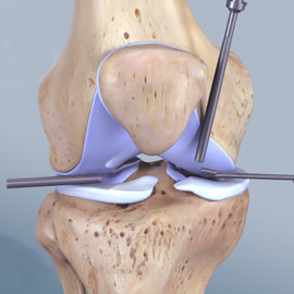 Откачка жидкости из коленного сустава