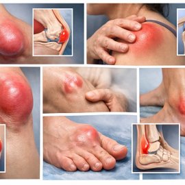 Причины бурсита