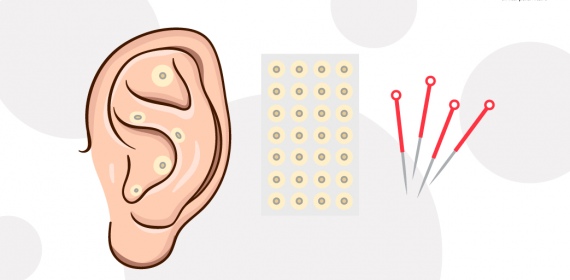 Аурикулотерапия