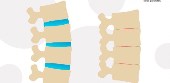 Болезнь Бехтерева