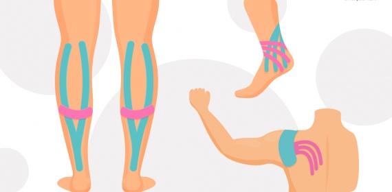 Кинезиотейпирование