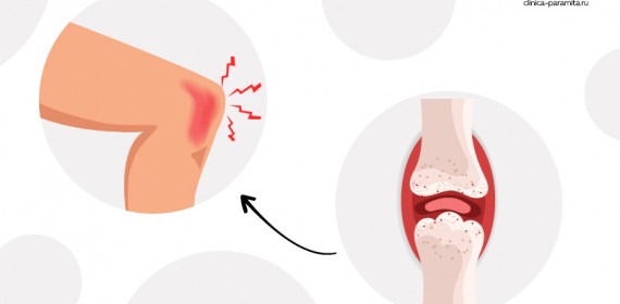 Артрит — лечение и симптомы заболевания, причины появления, диагностика, какой врач лечит