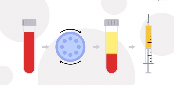 Плазмотерапия