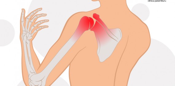 Плечелопаточный периартрит: симптомы и лечение - Центр доктора Бубновского