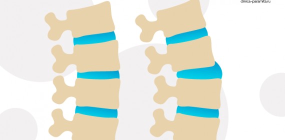 Подвывихи позвонков и смещение