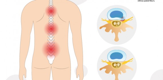 Протрузия диска в поясничном отделе