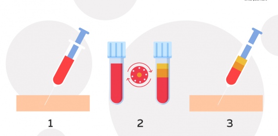 PRP-терапия в Москве