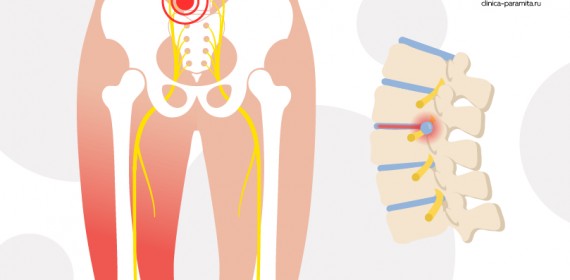 Поясничный радикулит: симптомы, как лечить пояснично-крестцовый радикулит