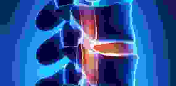 Грыжа Шморля