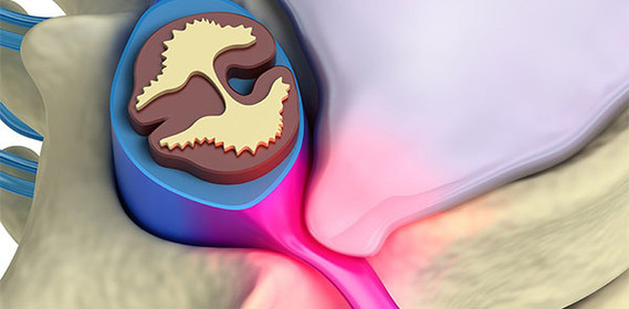 Лечение протрузии в Москве