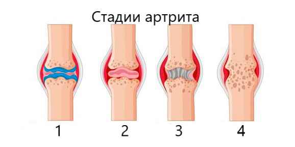 Стадии артрита
