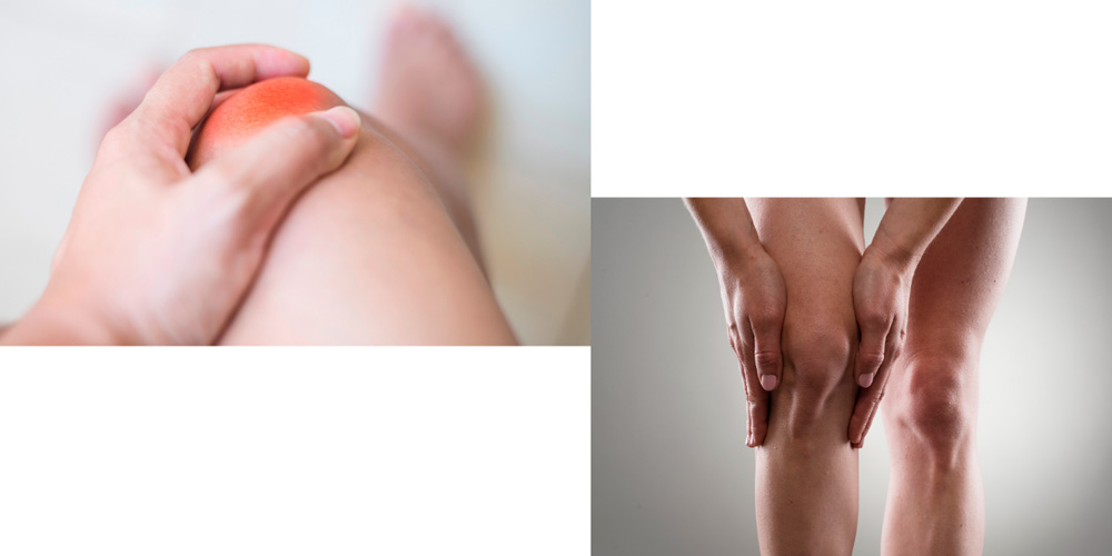 Симптомы артрита коленного сустава