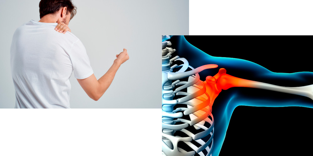 Артрит плечевого сустава — симптомы, лечение, терапия | Артриты