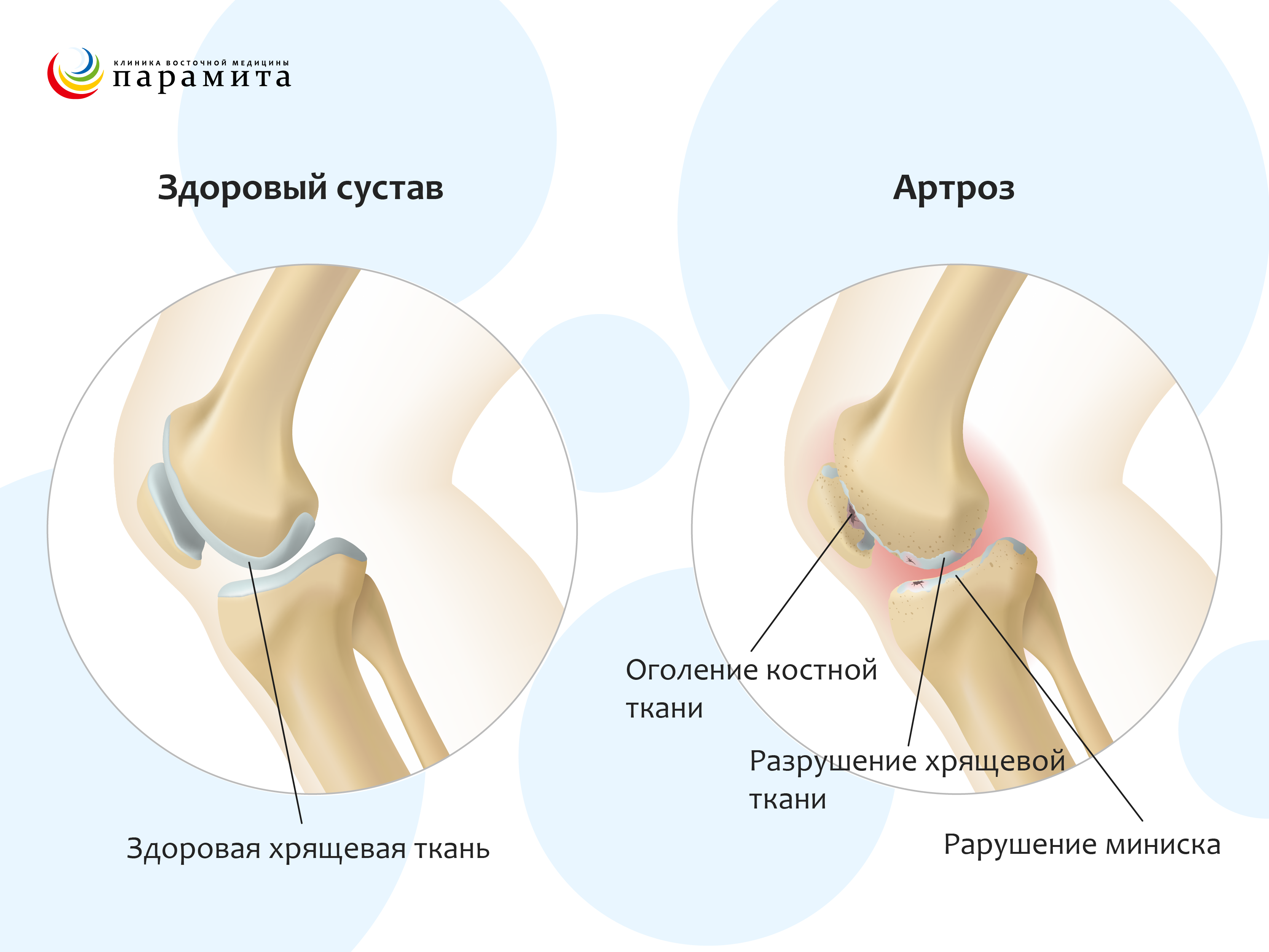 Артроз реберно-позвоночных суставов