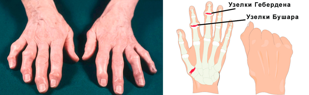 artroza ruku učinkovit tretman