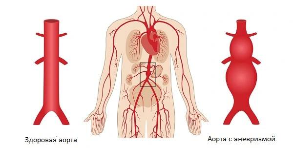 Аневризма аорты - патология, которая сопровождается болями в пояснице