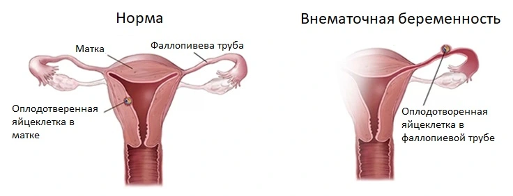 Внематочная беременность - опасная патология, которая проявляется болями в пояснице и животе