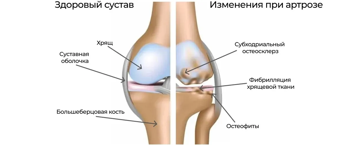 Здоровый и пораженный деформирующим остеоартрозом сустав