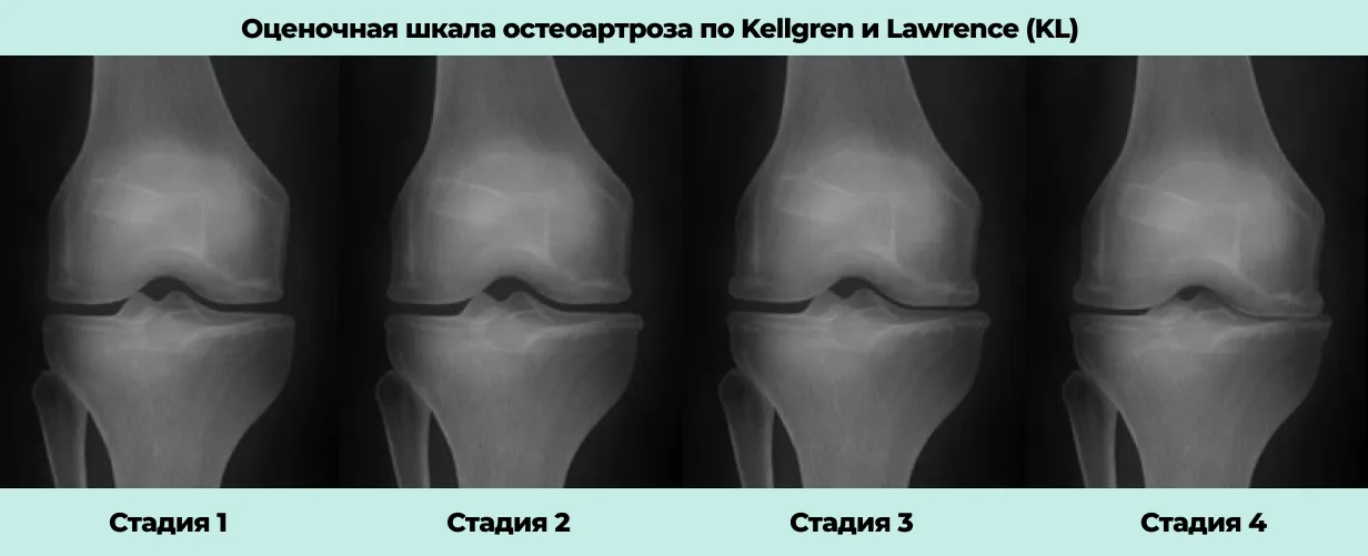 Стадии развития деформирующего остеоартроза