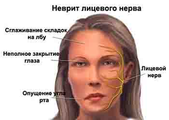 Основные признаки неврита лицевого нерва