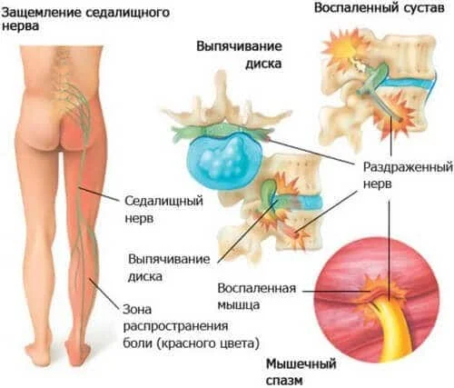 Патогенез защемления седалищного нерва