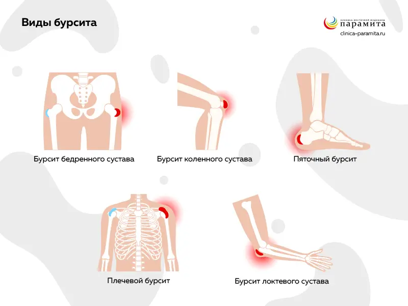 Формы и признаки бурсита