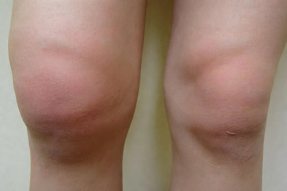 Как выглядит бурсит коленного сустава