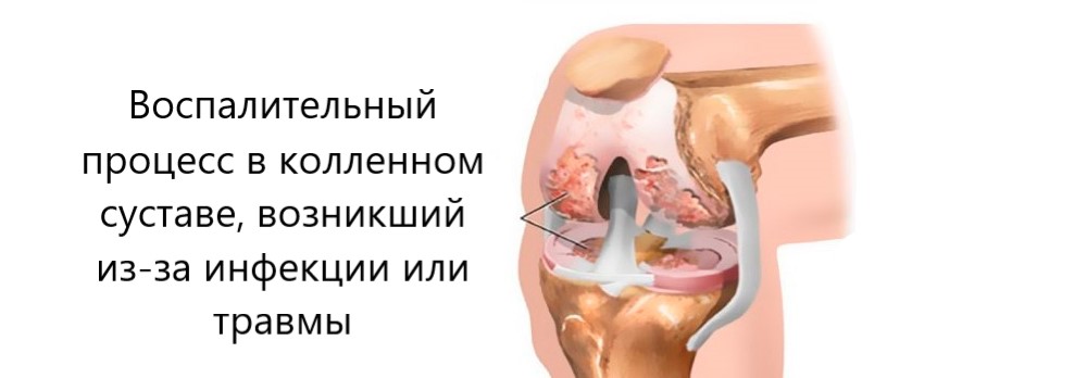 Артрит тазобедренного сустава: симптомы лечение коксартрита в Москве