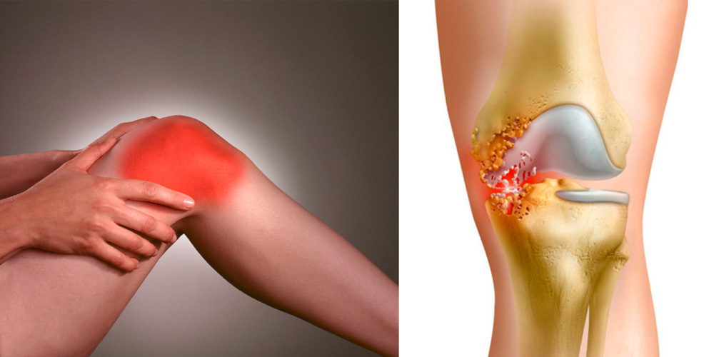 Гонартроз коленного сустава – лечение 1, 2, 3 степени