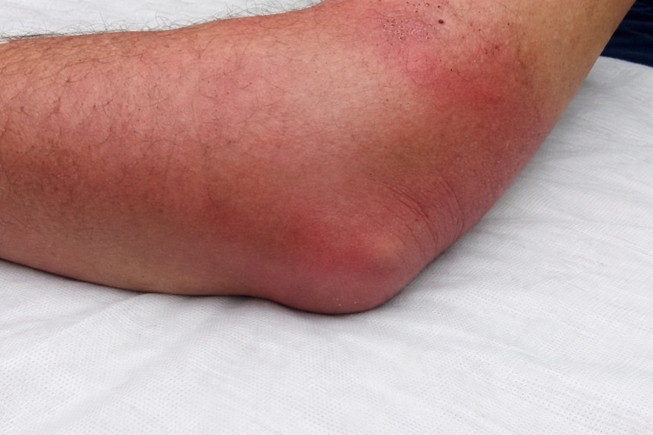 Локтевой гнойный бурсит