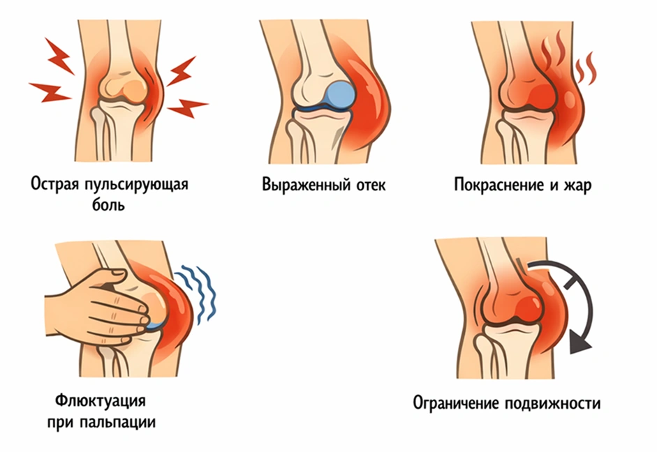 Местные симптомы гнойного бурсита