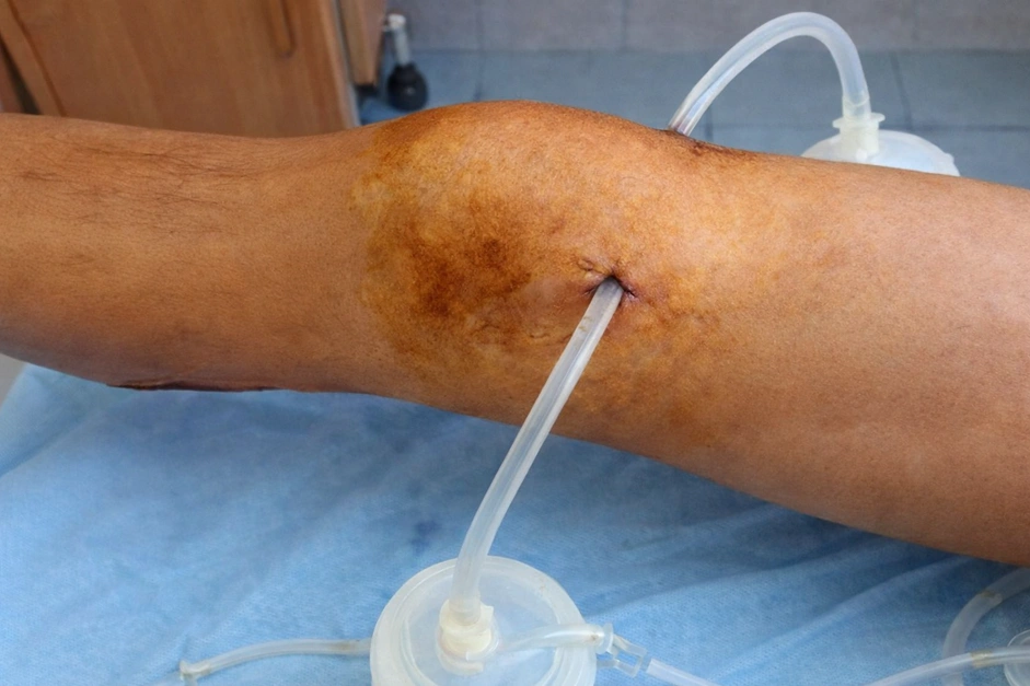 Дренаж после операции по удалению гноя