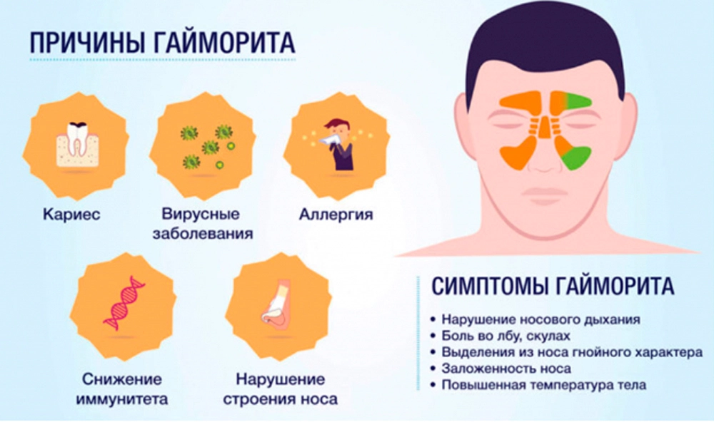 Хронический гайморит – симптомы, причины, признаки, диагностика и лечение в «СМ-Клиника»